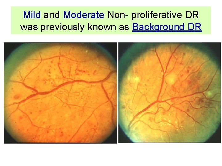 Mild and Moderate Non- proliferative DR was previously known as Background DR 