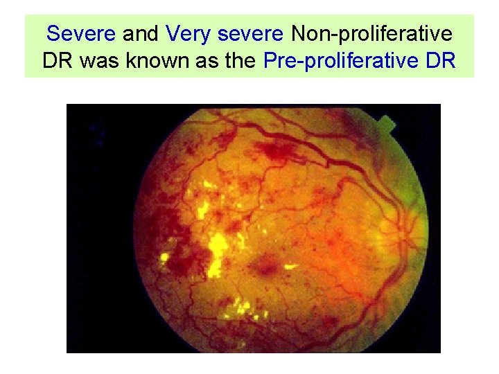 Severe and Very severe Non-proliferative DR was known as the Pre-proliferative DR 