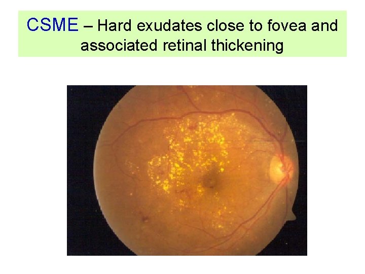 CSME – Hard exudates close to fovea and associated retinal thickening 