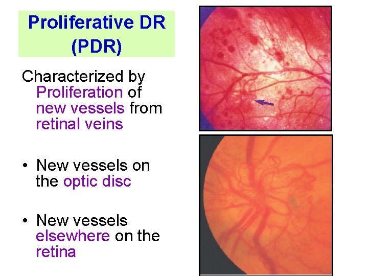 Proliferative DR (PDR) Characterized by Proliferation of new vessels from retinal veins • New
