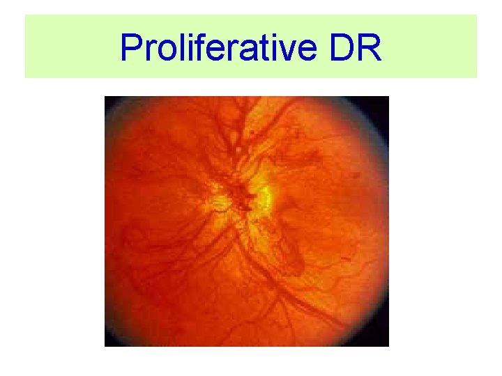 Proliferative DR NVD 