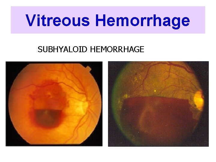 Vitreous Hemorrhage SUBHYALOID HEMORRHAGE 