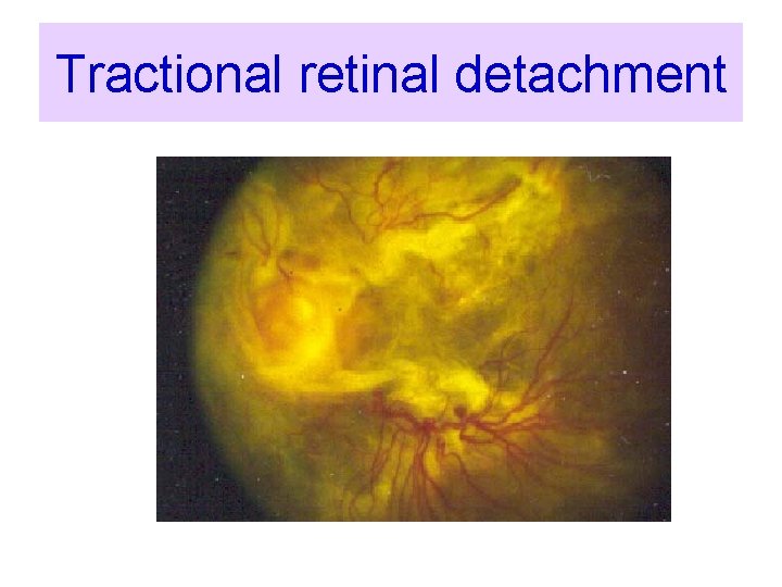 Tractional retinal detachment 