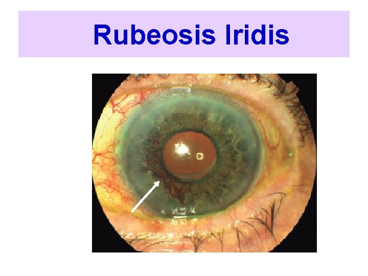  Rubeosis Iridis 