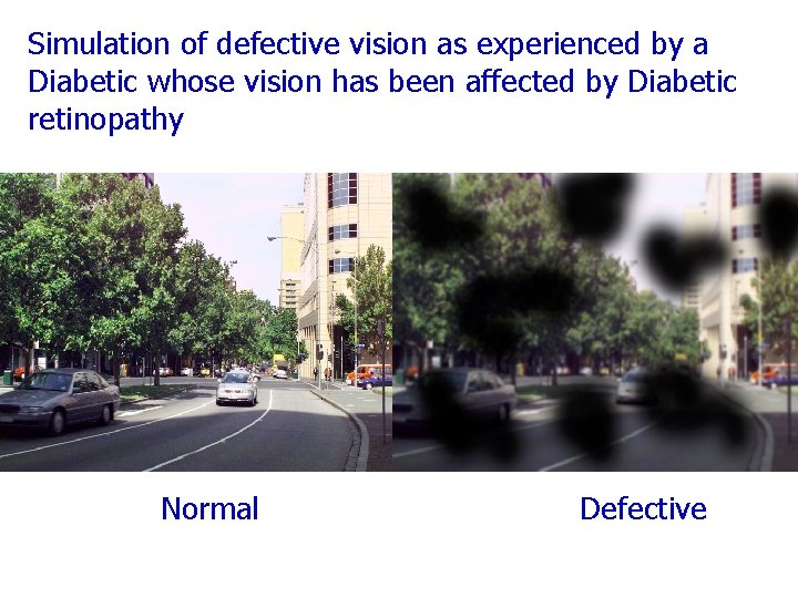 Simulation of defective vision as experienced by a Diabetic whose vision has been affected
