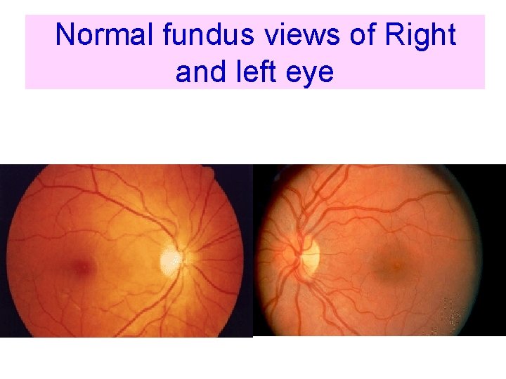 Normal fundus views of Right and left eye 