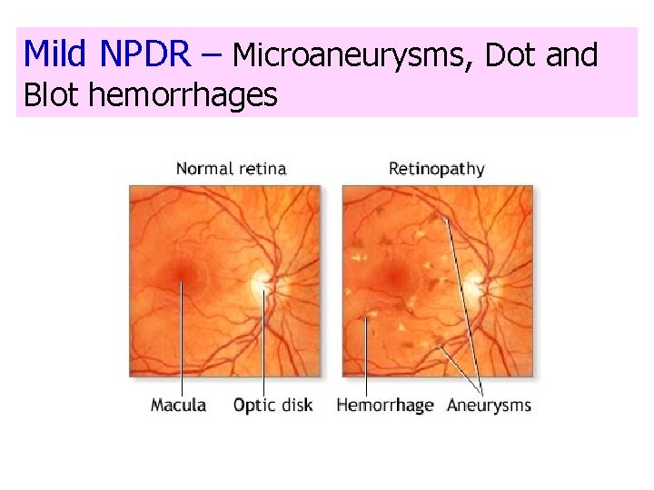 Mild NPDR – Microaneurysms, Dot and Blot hemorrhages 