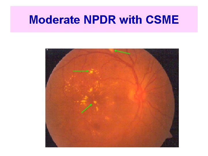 Moderate NPDR with CSME 