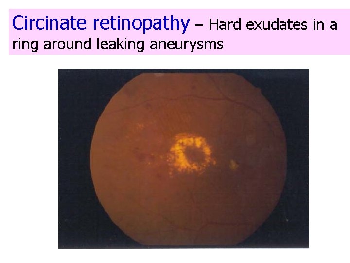 Circinate retinopathy – Hard exudates in a ring around leaking aneurysms 