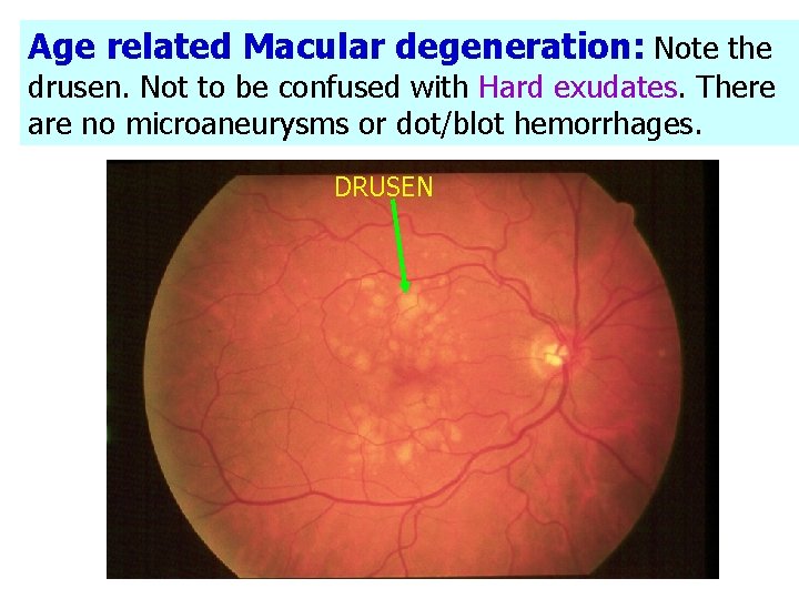 Age related Macular degeneration: Note the drusen. Not to be confused with Hard exudates.