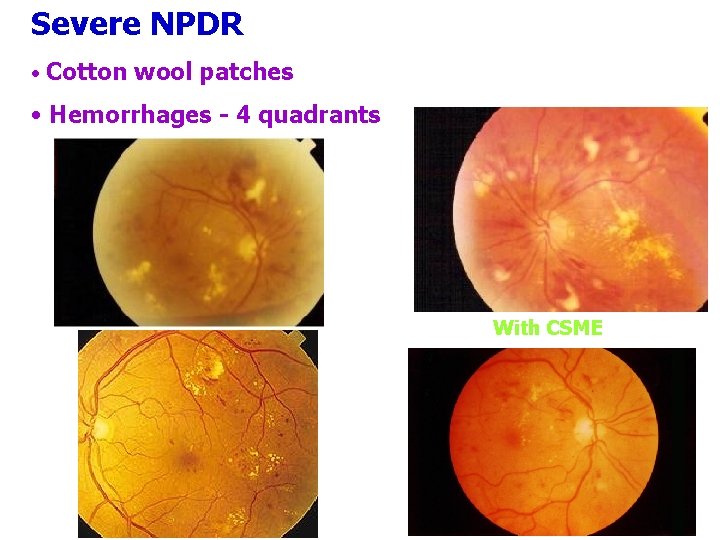 Severe NPDR • Cotton wool patches • Hemorrhages - 4 quadrants With CSME 