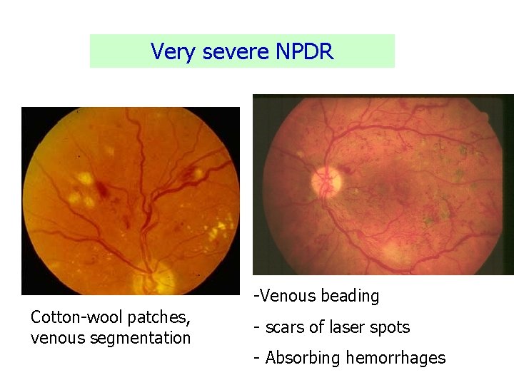 Very severe NPDR -Venous beading Cotton-wool patches, venous segmentation - scars of laser spots