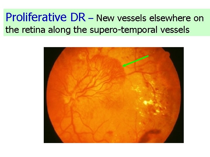 Proliferative DR – New vessels elsewhere on the retina along the supero-temporal vessels 