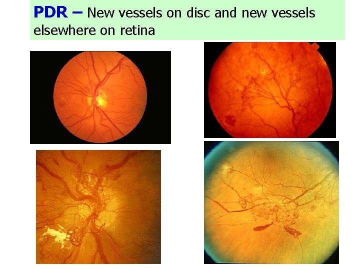 PDR – New vessels on disc and new vessels elsewhere on retina 