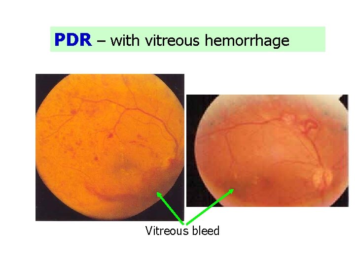 PDR – with vitreous hemorrhage Vitreous bleed 