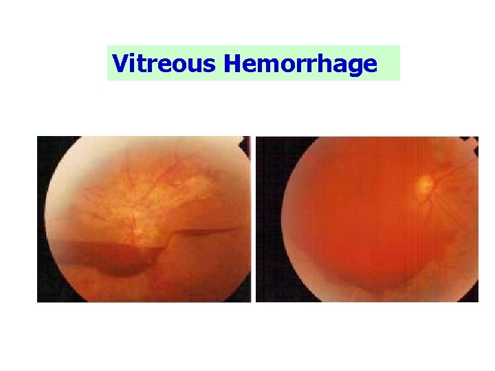 Vitreous Hemorrhage 