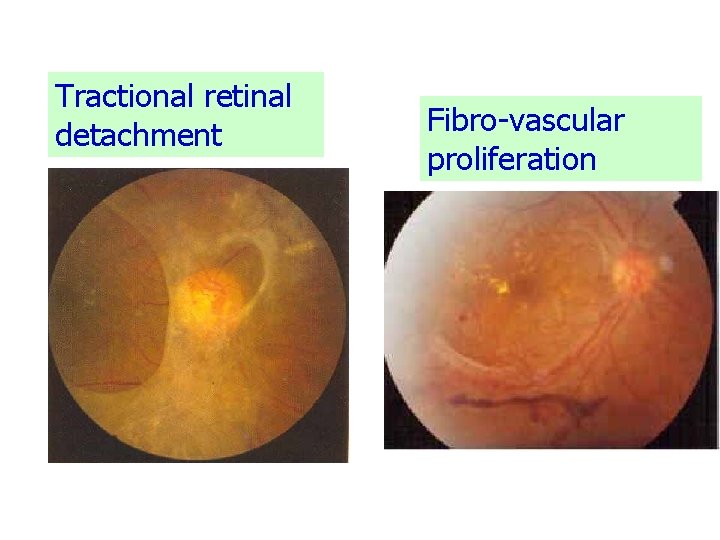 Tractional retinal detachment Fibro-vascular proliferation 