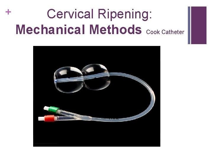 + Cervical Ripening: Mechanical Methods Cook Catheter 