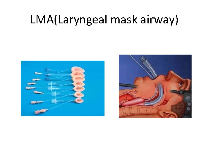 LMA(Laryngeal mask airway) 