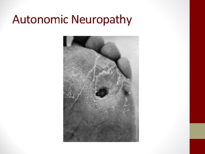 Autonomic Neuropathy 