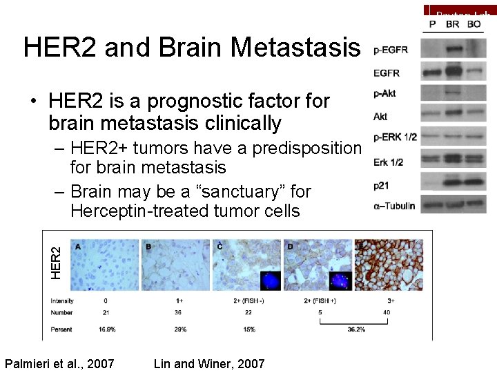 Peyton Lab HER 2 and Brain Metastasis • HER 2 is a prognostic factor