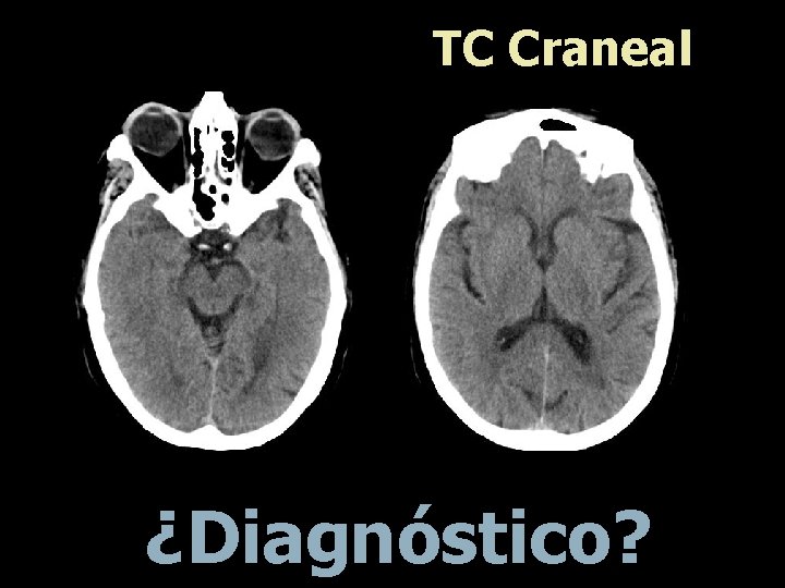 TC Craneal ¿Diagnóstico? 