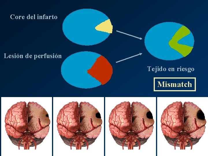 Core del infarto Lesión de perfusión Tejido en riesgo Mismatch 
