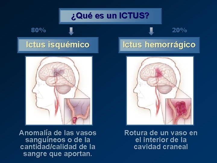 ¿Qué es un ICTUS? 80% 20% Ictus isquémico Ictus hemorrágico Anomalía de las vasos