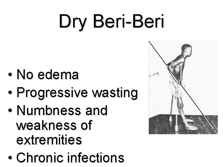 Dry Beri-Beri • No edema • Progressive wasting • Numbness and weakness of extremities Dry Beri-Beri • No edema • Progressive wasting • Numbness and weakness of extremities