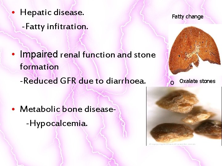  • Hepatic disease. -Fatty infitration. • Impaired renal function and stone formation -Reduced