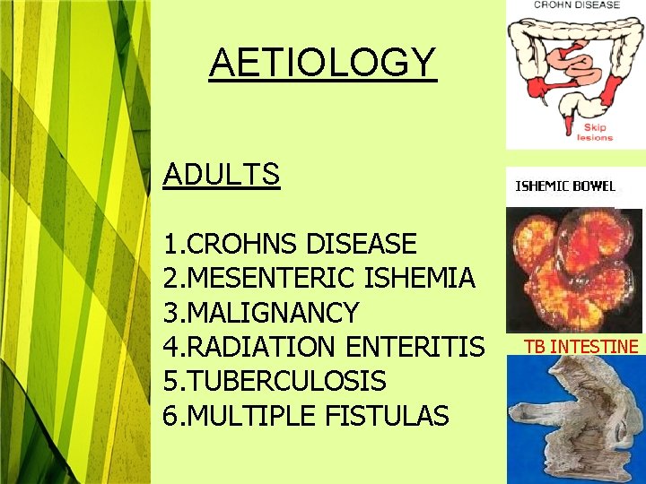 AETIOLOGY ADULTS 1. CROHNS DISEASE 2. MESENTERIC ISHEMIA 3. MALIGNANCY 4. RADIATION ENTERITIS 5.