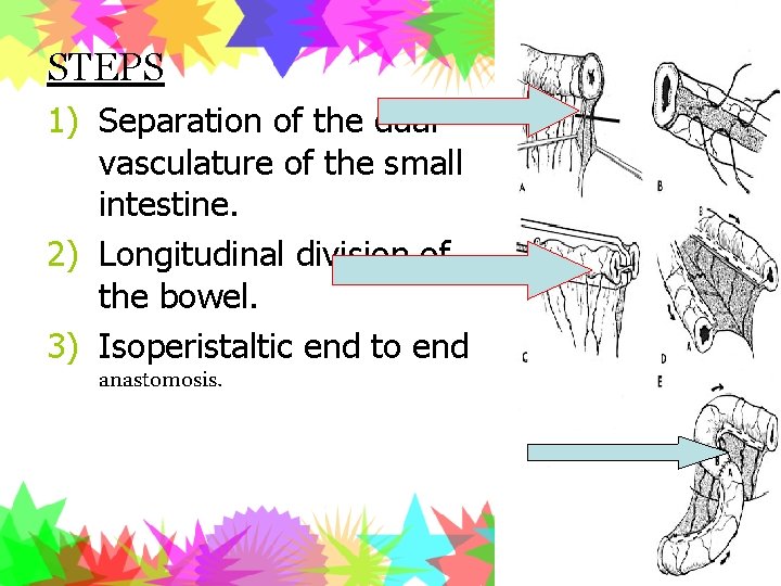 STEPS 1) Separation of the dual vasculature of the small intestine. 2) Longitudinal division