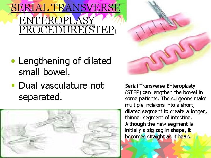 SERIAL TRANSVERSE ENTEROPLASY PROCEDURE(STEP) • Lengthening of dilated small bowel. § Dual vasculature not