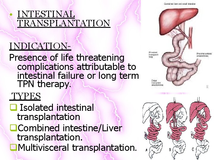  • INTESTINAL TRANSPLANTATION INDICATIONPresence of life threatening complications attributable to intestinal failure or
