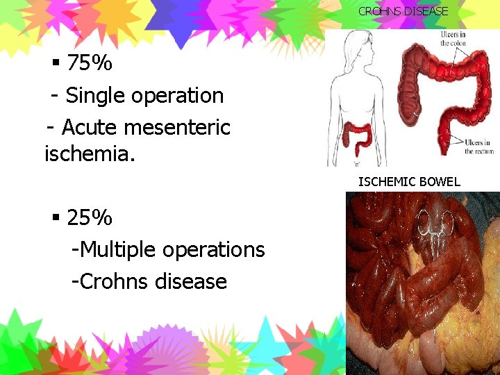 CROHNS DISEASE § 75% - Single operation - Acute mesenteric ischemia. ISCHEMIC BOWEL §