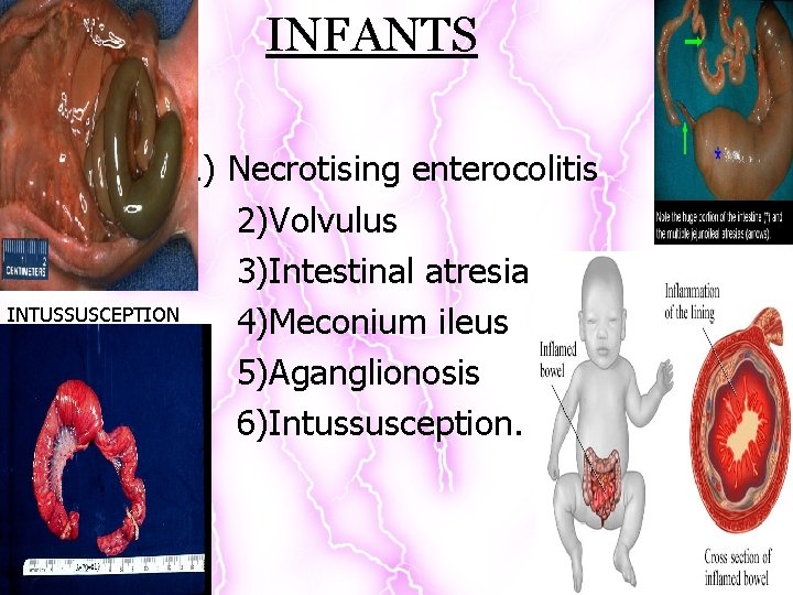 INFANTS 1) Necrotising enterocolitis 2)Volvulus 3)Intestinal atresia INTUSSUSCEPTION 4)Meconium ileus 5)Aganglionosis 6)Intussusception. 