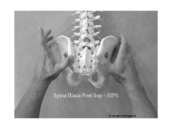 Spina Iliaca Post Sup - SIPS 