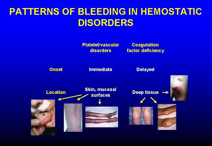 PATTERNS OF BLEEDING IN HEMOSTATIC DISORDERS Platelet/vascular disorders Coagulation factor deficiency Onset Immediate Delayed