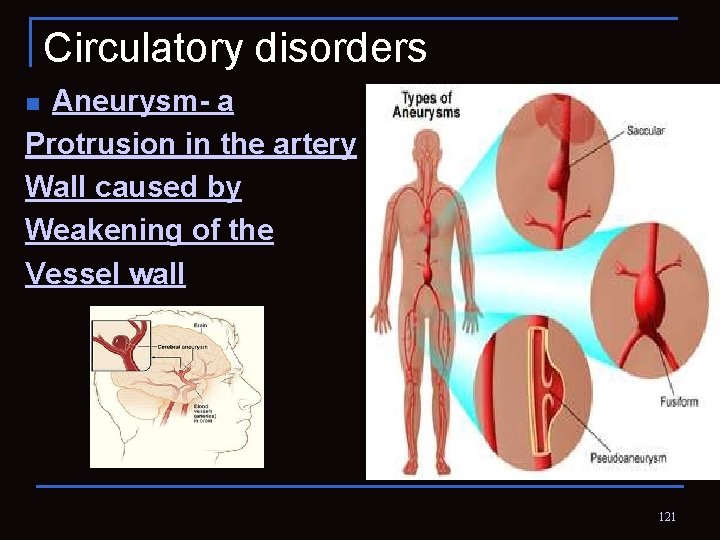 Circulatory disorders Aneurysm- a Protrusion in the artery Wall caused by Weakening of the