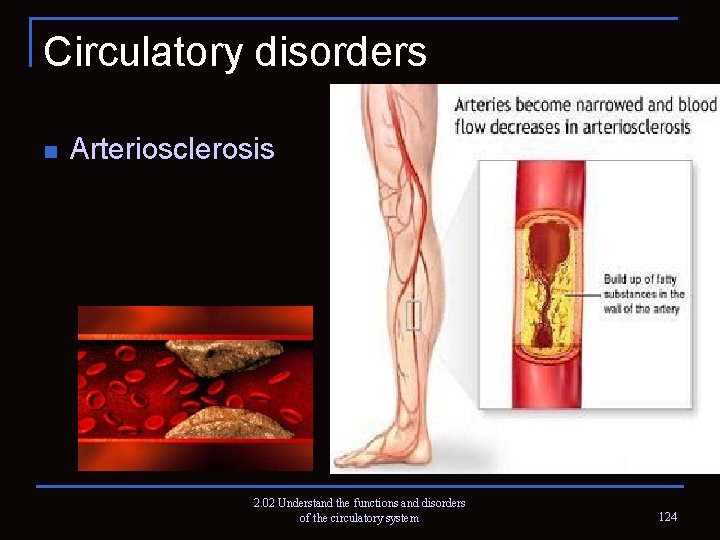 Circulatory disorders n Arteriosclerosis 2. 02 Understand the functions and disorders of the circulatory