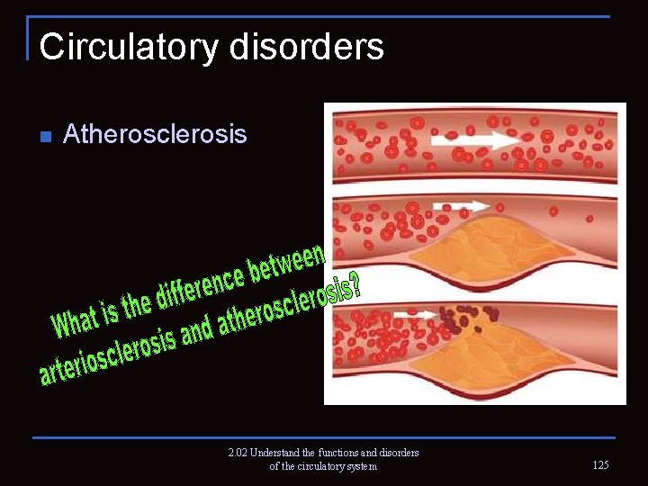 Circulatory disorders n Atherosclerosis 2. 02 Understand the functions and disorders of the circulatory