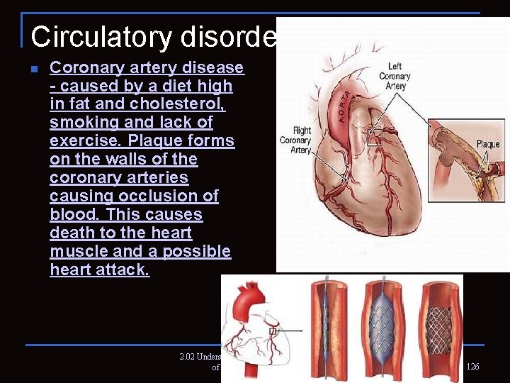 Circulatory disorders n Coronary artery disease - caused by a diet high in fat