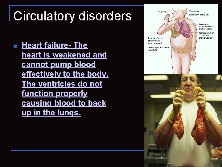 Circulatory disorders n Heart failure- The heart is weakened and cannot pump blood effectively
