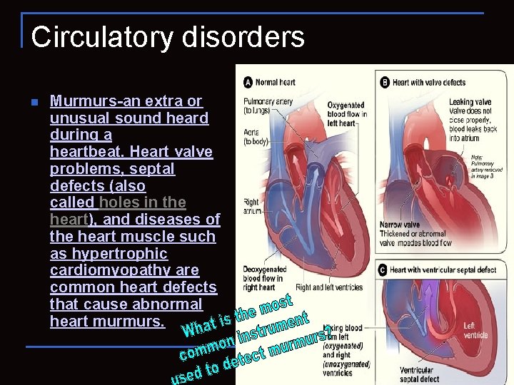Circulatory disorders n Murmurs-an extra or unusual sound heard during a heartbeat. Heart valve