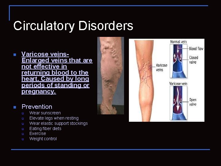 Circulatory Disorders n Varicose veins- Enlarged veins that are not effective in returning blood