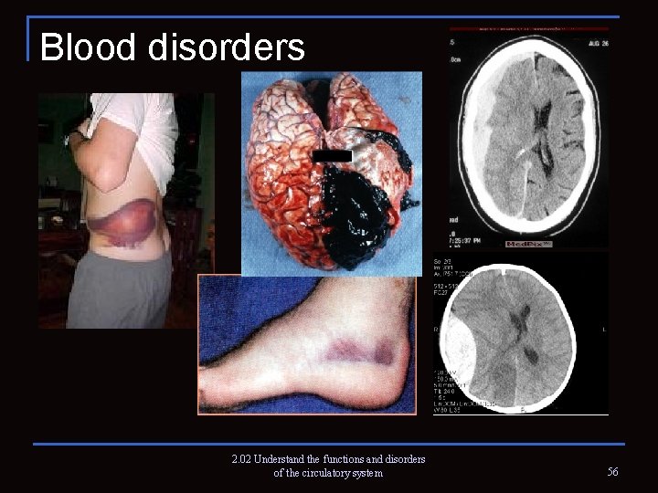 Blood disorders 2. 02 Understand the functions and disorders of the circulatory system 56