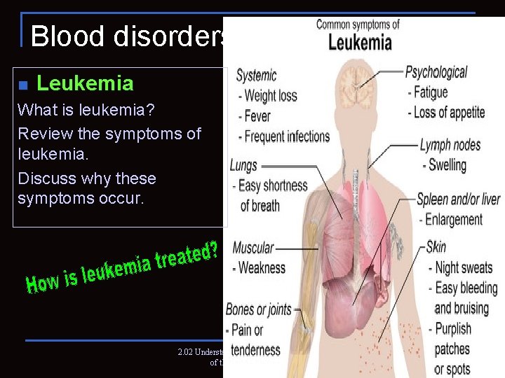 Blood disorders n Leukemia What is leukemia? Review the symptoms of leukemia. Discuss why