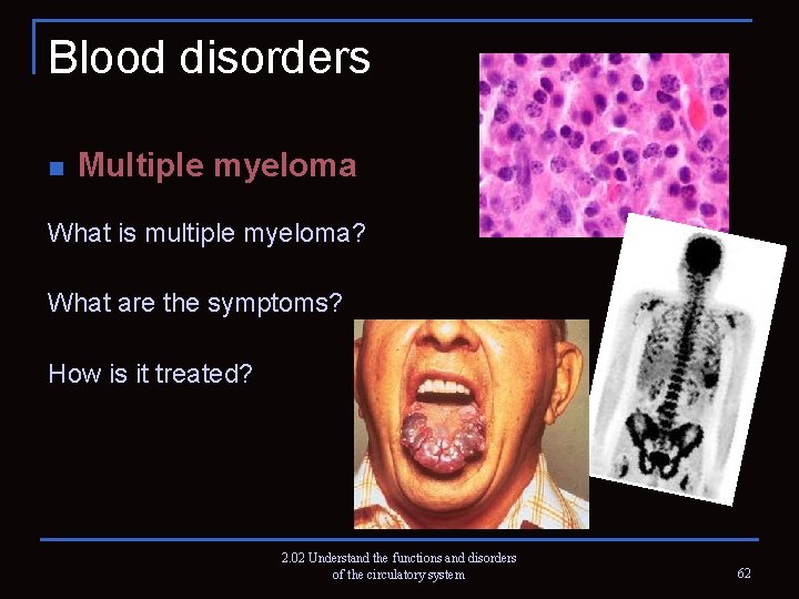 Blood disorders n Multiple myeloma What is multiple myeloma? What are the symptoms? How