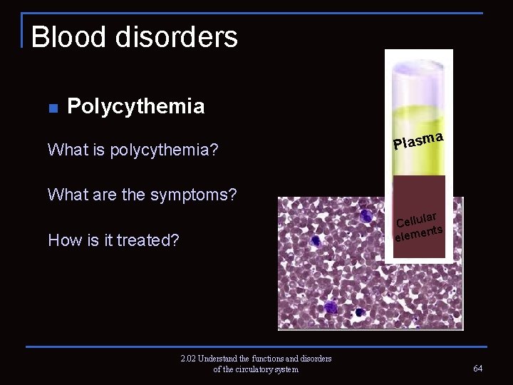 Blood disorders n Polycythemia What is polycythemia? a Plasm What are the symptoms? lar