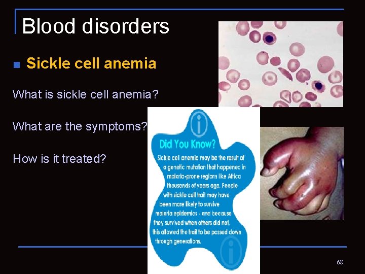 Blood disorders n Sickle cell anemia What is sickle cell anemia? What are the